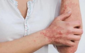 El fin de la viruela del mono: La OMS dio por terminada la emergencia sanitaria global