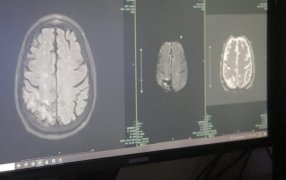 Posadas: Desde el Hospital Dr. Ramón Madariaga destacan las señales de alerta del ACV para detectarlo a tiempo