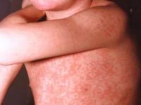 Alerta por sarampión: El 