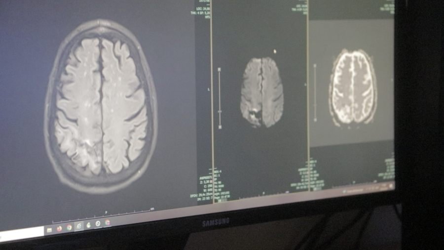 Posadas: Desde el Hospital Dr. Ramón Madariaga destacan las señales de alerta del ACV para detectarlo a tiempo